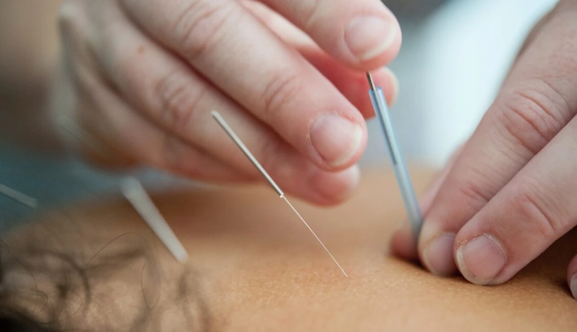 pessoa com agulhas de acupuntura