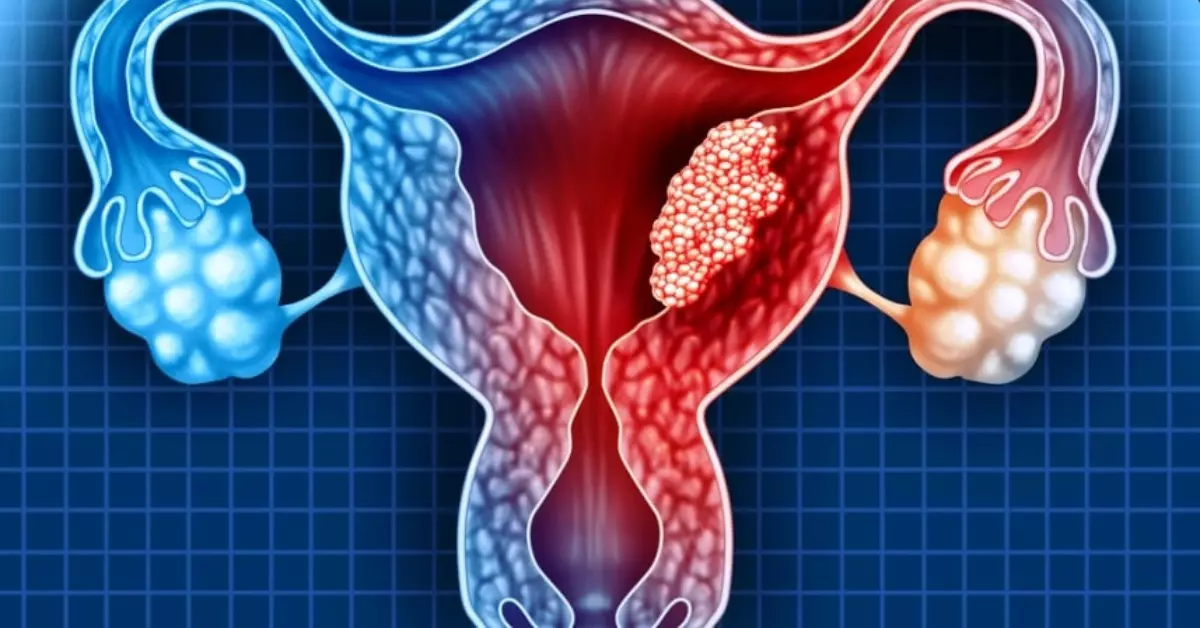ilustração de câncer de colo de útero