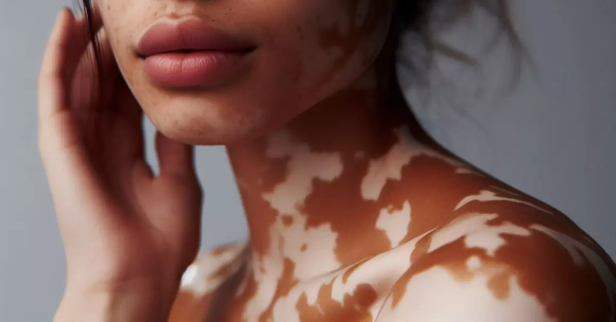 uma mulher com vitiligo
